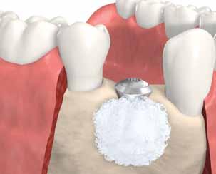 Dental implant placement for patients with insufficient bone volume. Straumann bone graft solutions 1 Some patients may not have enough bone to support a dental implant.