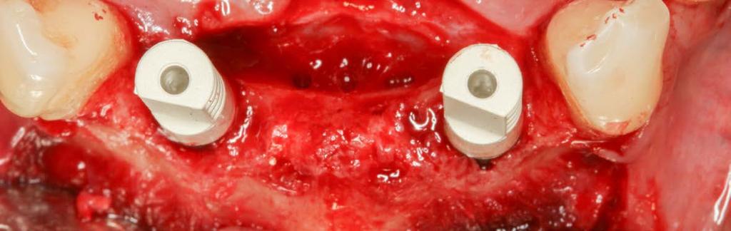 to suturing. Fig. 22: the inserted interim denture.