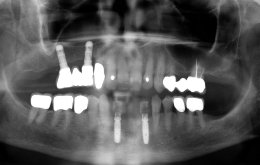 Fig. 32 828 Fig. 28: panorama x-ray following insertion of one implant each in regio 42 and 32 and the immediate restoration with the converted interim denture.