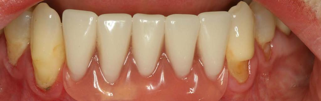 2: until now, the patient has been treated with an interim denture attached via brackets.