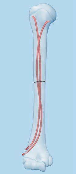 Slika 7. Prikaz titanskog elastičnog čavla (TEN) i njegovog položaja u kosti Preuzeto iz Titanium/stainless steel elastic nail system for Elastic stable intramedullary nailing (ESIN).