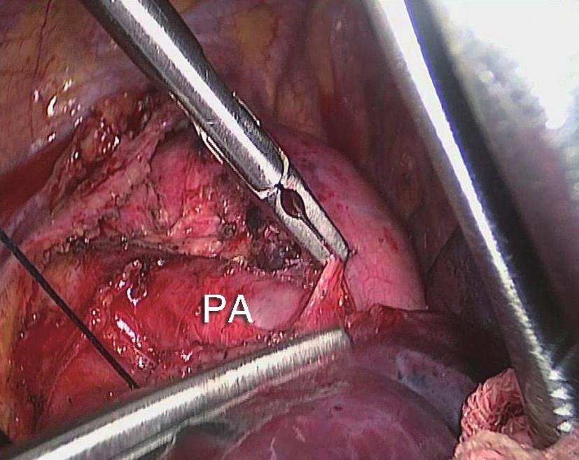 Step 2: opening the posterior mediastinal pleura and exploring the tissues posterior to the hilum The posterior mediastinal pleura were opened towards superiorly, to determine whether there were any