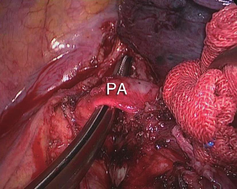 1858 Dong et al. Radical VATS lobectomy under pulmonary artery clamping resected under left pulmonary artery clamping.