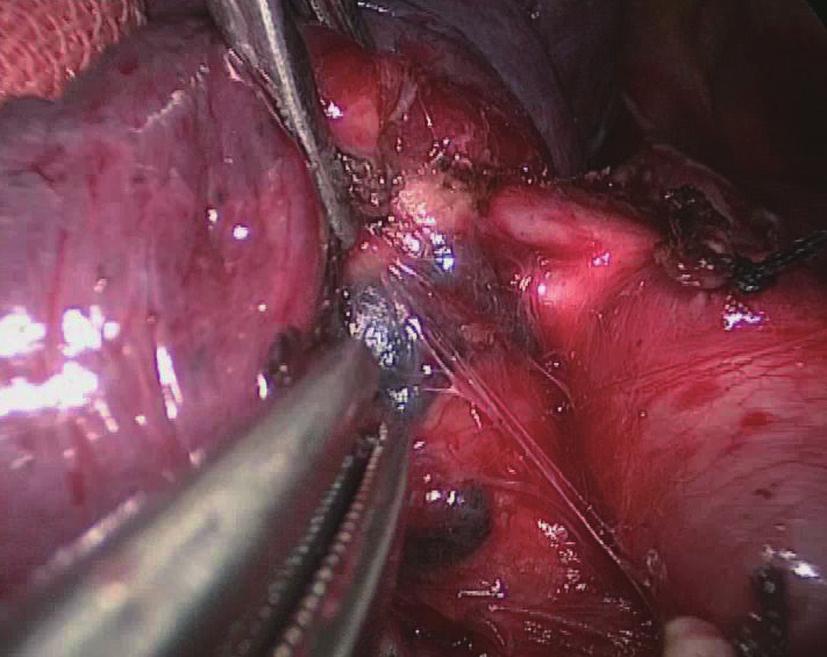 Step 7: complete mobilization of the proximal left main pulmonary and the dissection of station 4 lymph nodes Figure 6 There were stiff lymph nodes adhering to the apical artery.