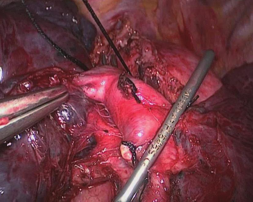 Journal of Thoracic Disease, Vol 6, No 12 December 2014 1859 however, the lymph nodes did not fully cover the artery.