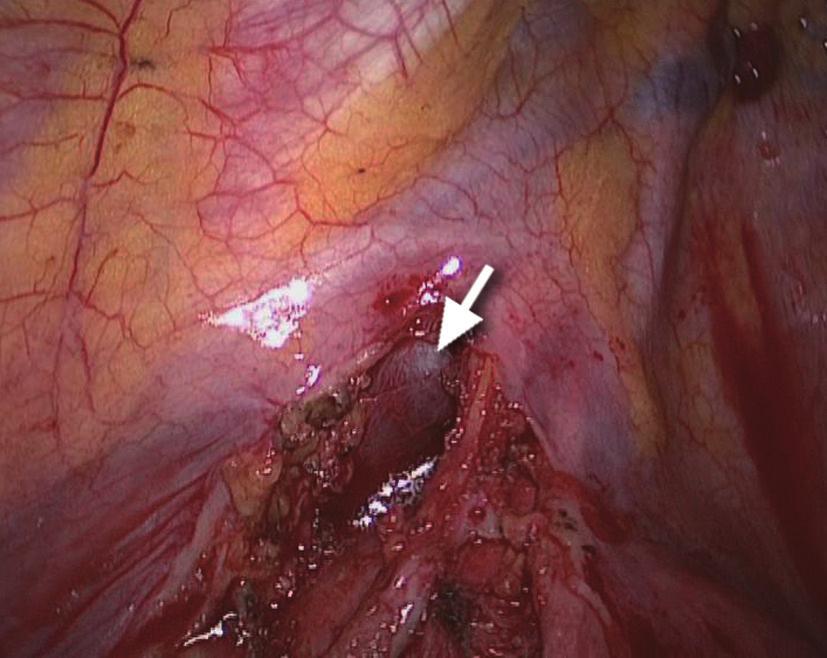 Step 11: transection of the left upper lobe bronchus Figure 9 The left inferior pulmonary artery were clamped using another endoscopic bulldog clamp.