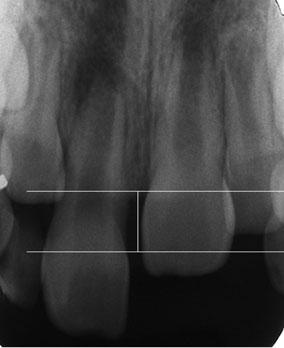 2 Tsilingaridis et al. healing, degree of intrusion and root development in intrusive luxated permanent teeth.