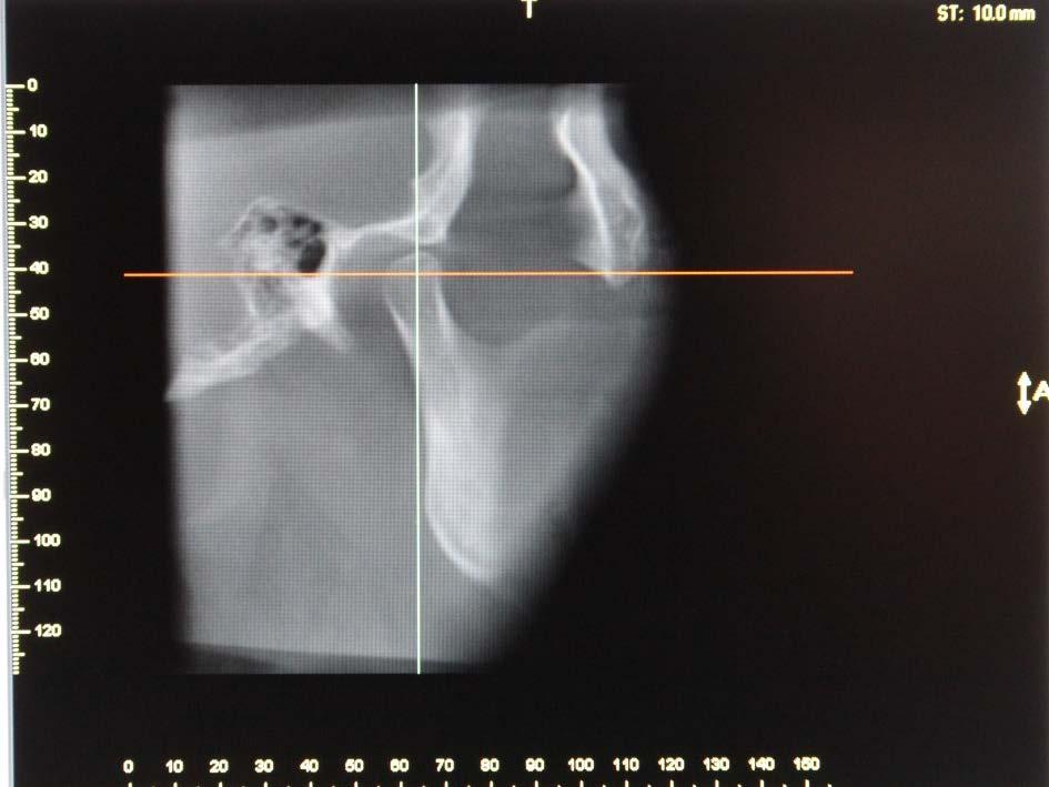 RADIOGRAPHS BEFORE TREATMENT: Tomograms Maximum Open: Right TM Joint