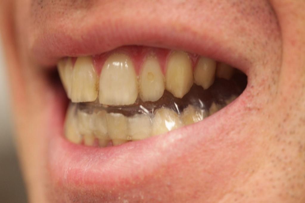 Smile After Treatment -