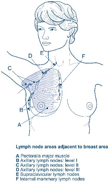 Symptoms Some breast changes may be early signs of breast cancer, including: a lump or lumpiness thickening of the tissue nipple changes, for example a blood-stained discharge from one nipple, an