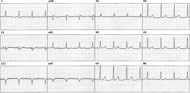The 12-lead electrocardiogram of a patient with