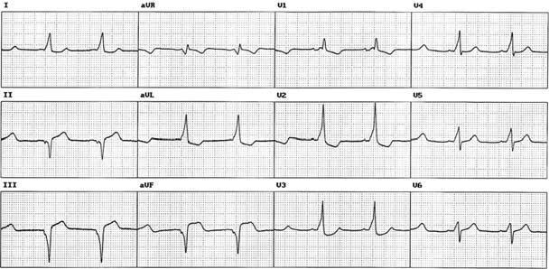 The 12-lead electrocardiogram of a patient with manifest epicardial