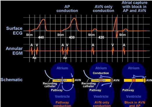- Pacing at a more rapid rate causes block in the accessory pathway and subsequently block in the AV node,
