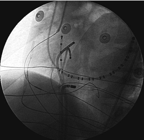LAO: + Ablation catheter placed near the ostium of the middle