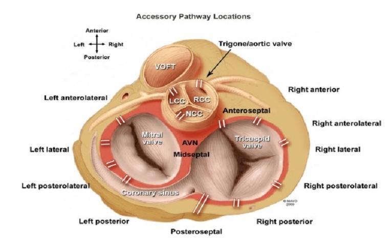 Ventricle space (thin tissue: AP inside) + CS os: at the superior (ablation site) 4 courses: Right to