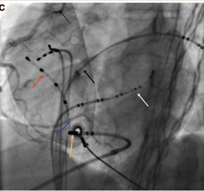 - A coronary angiogram was performed to ensure that the ablation catheter was not in close proximity to one of the epicardial coronary arteries -The accessory pathway was eliminated after 6.