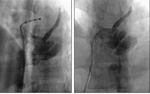 Monther Boulos report a case: -Two previous attempts had failed to ablate the posteroseptal AP - The presence of a large bilobar