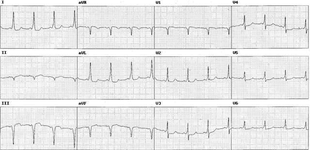 The 12-lead electrocardiogram of a patient with manifest