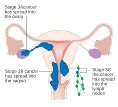 ndometrial Cancer Stage 2 invasive into the cervix ndometrial Cancer 3A Spread to ovary or tube 3B Vaginal or parametrial invasion 3C1 spread to pelvic nodes
