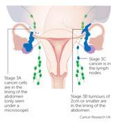Ovarian Cancer Ovarian Cancer Ovarian Cancer Stage 3 disease outside of pelvis 3A microscopic