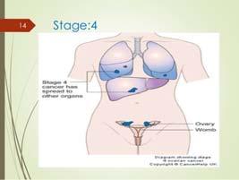 Ovary Stage 4 disease in liver or above the diaphragm HPV what is it?