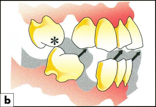 7- Occlusion of the natural teeth (static teeth relation): a) Minor occlusal discrepancy: -Deflective