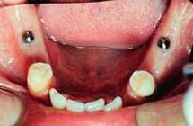 Implant denture Indications: Patients