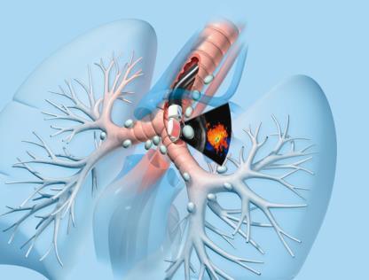 Updates in Interventional Pulmonary Medicine Eric J.