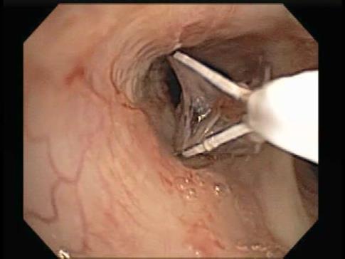 Bronchial Thermoplasty for Severe Asthma - 3 Procedures, 3 weeks apart - Deliver Thermal Energy to airway smooth muscle - Most common side effect is asthma exacerbation -
