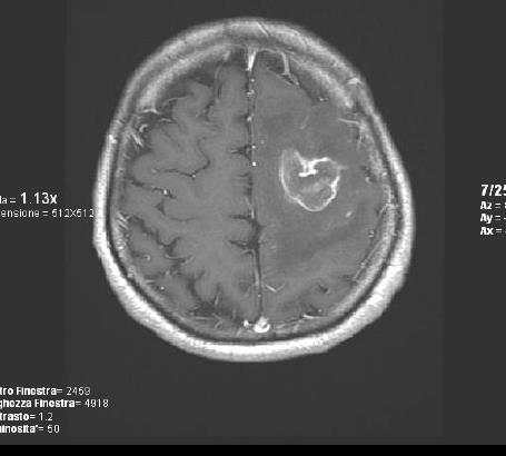 Single brain met in a young patients with lung adenocarcinoma
