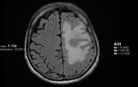 seizures MRI after 6 months From SRT: Increasing number of seizures