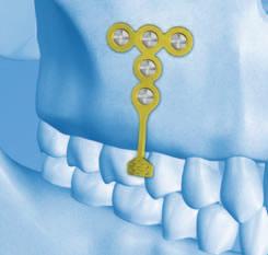 Orthodontic Bone Anchor (OBA) System. Skeletal implants for the orthodontic movement of teeth.