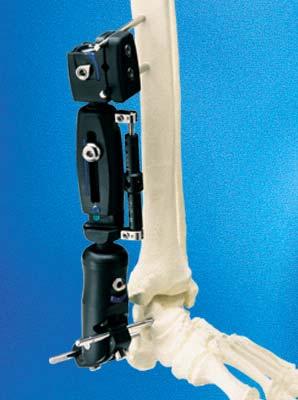 Orthopedic Business- Fracture Repair XCaliber
