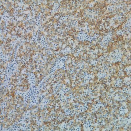 Thymoma Cytokeratin stains reveal a meshwork of