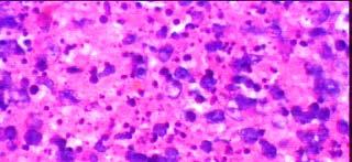 Graph 1: WBC Counts Fine needle aspiration cytology on one of the cervical lymph nodes was done and showed reactive hyperplasia suggestive of a viral etiology.