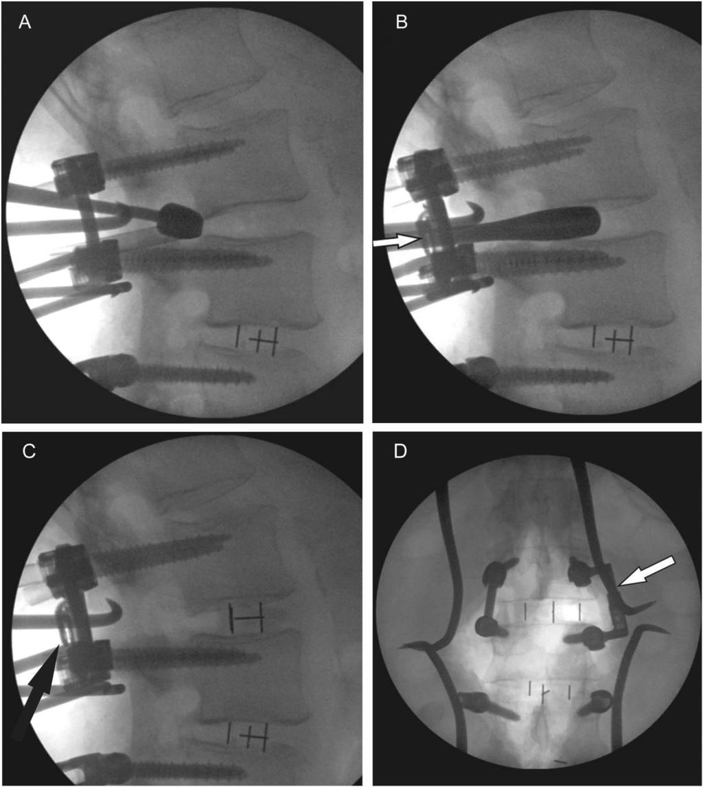 IPSILATERAL EXPANDABLE ROD IN TLIF FIGURE 4. Lateral fluoroscopic images demonstrating the application of the ipsilateral provisional expandable rod.