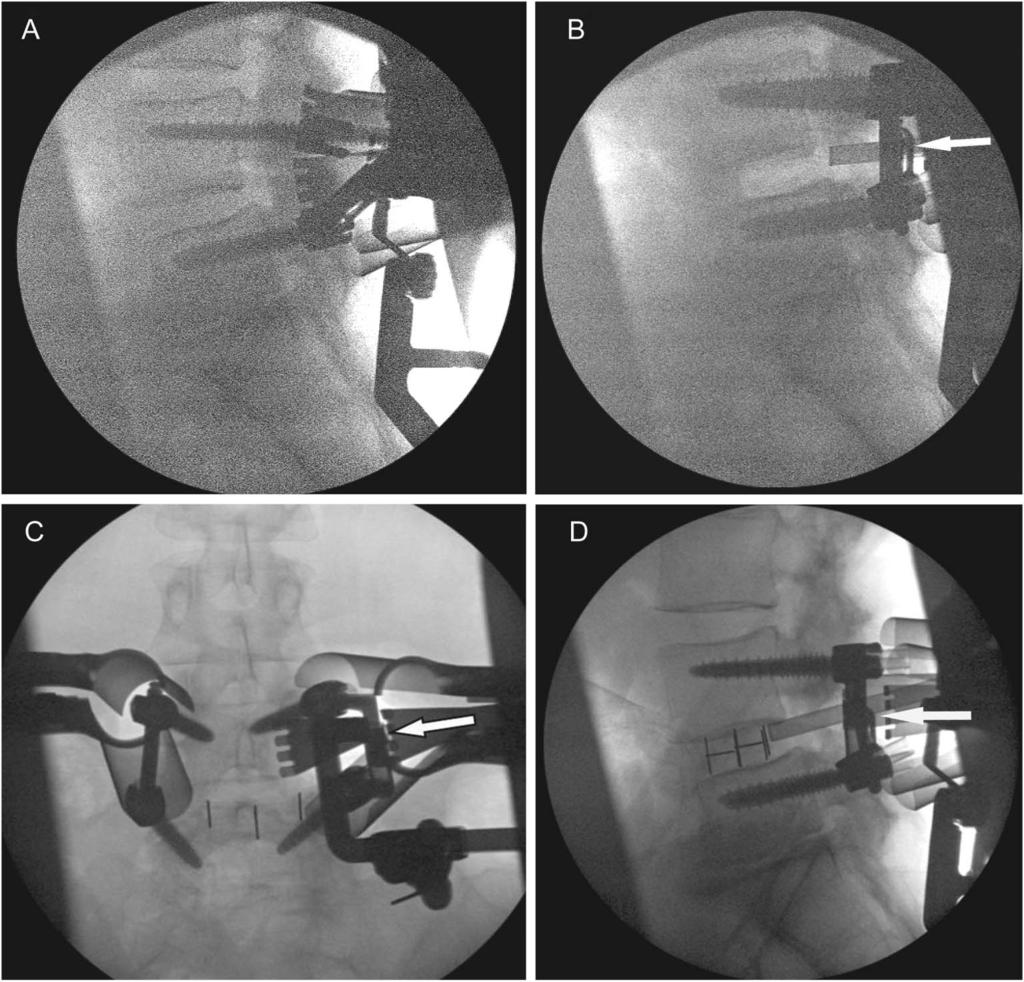 TUMIALÁN ETAL FIGURE 5. A, lateral fluoroscopic image with 4 pedicles in position before distraction of the disc space. B, provisional ipsilateral expandable rod in position as denoted by the arrow.