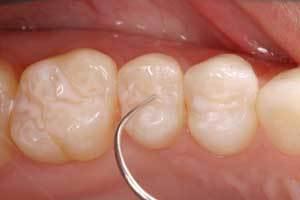 Remove nidus of caries: acidogenic bacteria Placement of sealants to seal and close pits and fissures and prevent the microorganisms to live.