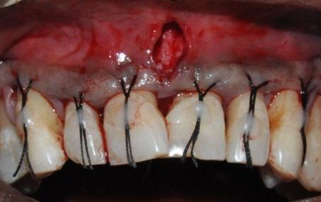 horizontal mattress sutures to the midcoronal position on the teeth.