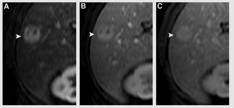 Cholangiocarcinoma in cirrhosis:absence of contrast washout in delayed phases by MRI avoids misdiagnosis of HCC Rimola J