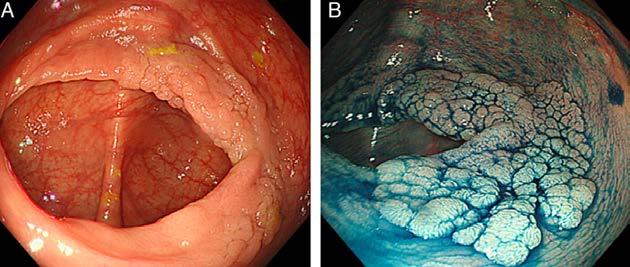 Chromoendoscopy An endoscopic technique that uses stains during endoscopy to highlight differences in mucosa, as well as dysplastic and malignant changes.