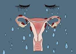 CONCLUSION Consider endometriosis in the presence of gynecological symptomssuch as dysmenorrhoea,pelvic pain, dispareunia, infertility and fatigue in the presence of any of the above Or in women of