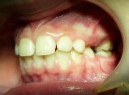 Dental: class II/1 Angle maloclusion, with