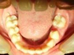 premature loss of deciduous teeth, reduced