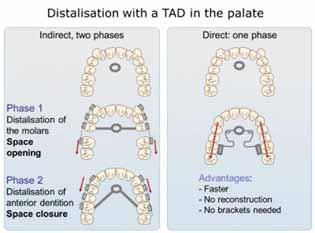 PENDULUM B APPLIANCE FOR MOLAR DISTALISATION Figure 1. Different strategies for maxillary molar distalisation using TADs in the anterior palate.