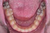 6 SNA, Angle Sella-Nasion-A point; SNB, Sella-Nasion-B point; ANB, Difference SNB-SNA; NL-ML, Palatal