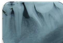 extraction of the mesial root of the first