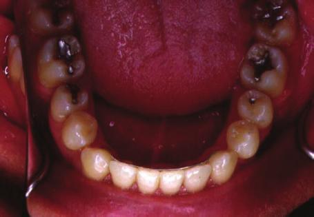 mesial movement avoiding its tipping. Class III elastics were used during this phase of the treatment.