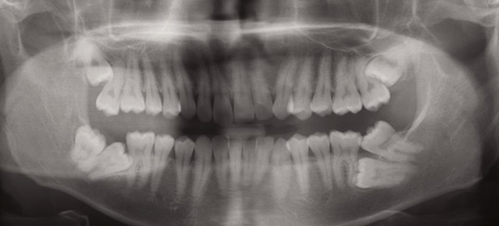 Simple Mechanics to Upright Horizontally Impacted Molars with Ramus Screws IJOI 40 Dr.