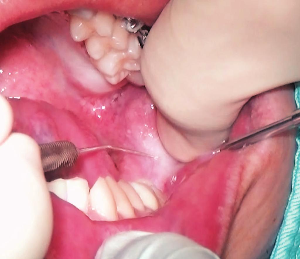 Simple Mechanics to Upright Horizontally Impacted Molars with Ramus Screws IJOI 40 Discussion Deciding between extraction or uprighting for impacted teeth is a critical aspect of treatment planning.
